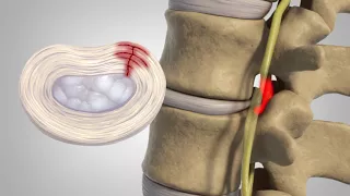Herniated Disc - Patient Education
