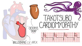 Takotsubo Cardiomyopathy Explained  (Broken Heart Syndrome)