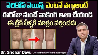 వెరికోస్ వెయిన్స్ కి వాకింగ్ | Walking for Varicose Veins | Varicose Veins Home Remedies | Dr Devu