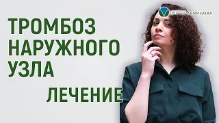 Тромбоз наружного узла.  Как лучше лечить?