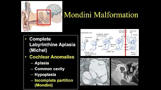 Suresh Mukherji.  Pre-op Imaging of Cochlear Implants