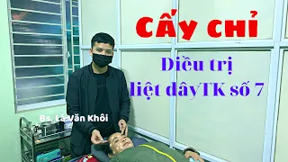 Cấy chỉ chữa liệt dây thần kinh số 7 | Bác sĩ Lá Văn Khôi