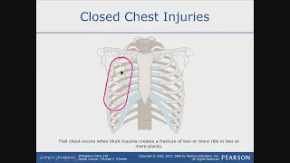 Chest Injury (Flail Chest) Lecture 2 / EMT MADE EASY