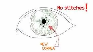 What is a Cornea Transplant?