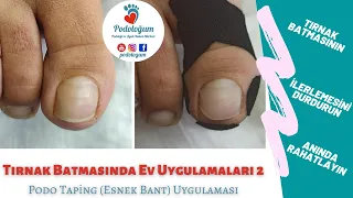 Tırnak Batmasında Esnek Bant/Kinesiobant Uygulaması (Ev Uygulamaları) Podotaping