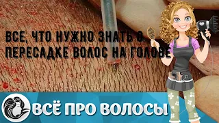 Все, что нужно знать о пересадке волос на голове