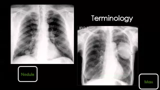 Chest X ray Suhag12 25 2014 11 51 15 AM