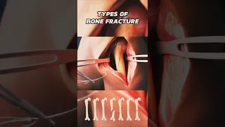 common types of bone fracture  #viral #shorts