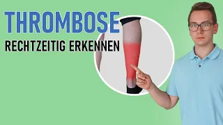 Thrombose: Habe ich eine Thrombose? Symptome und Anzeichen erkennen