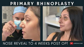 Primary Rhinoplasty | Nose Reveal to 4 Weeks Post Op?! | Nose By Ghavami