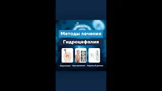 Методы лечения Гидроцефалия | NeuroLife | Dr. Davron Kadirov