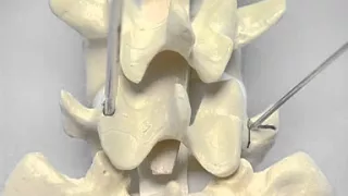 Pedicle Identification_spine surgery