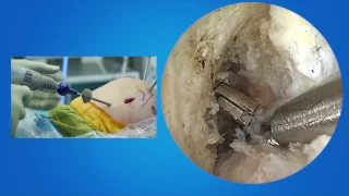 ACL Reconstruction with Reinforcement using the Internal Brace