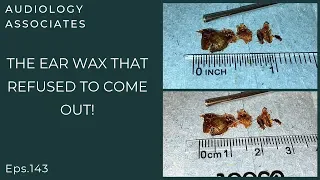 THE EAR WAX THAT REFUSED TO COME OUT - EP 143