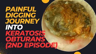 PAINFUL Digging Journey Into Keratosis Obturans (2nd Episode)