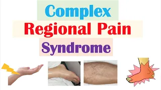 Complex Regional Pain Syndrome | Causes, Pathophysiology, Signs & Symptoms, Diagnosis, Treatment