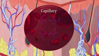 What is erythropoietic protoporphyria (EPP)?