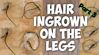 Hair Ingrown |long+curly|part 3