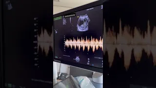 HEARING BABIES HEARTBEAT FOR THE FIRST TIME- 11 WEEKS PREGNANT