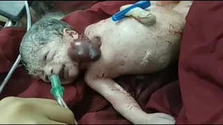 Baby born with Ectopia Cordis - heart outside the body