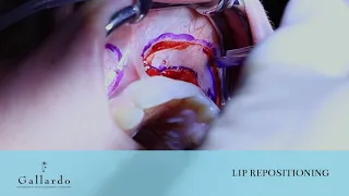 Lip Repositioning Surgery