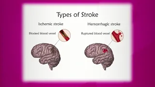 Types of Stroke