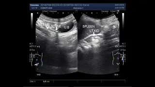 Ultrasound Video showing shrunken kidney with multiple renal stones and a stone in ureter.