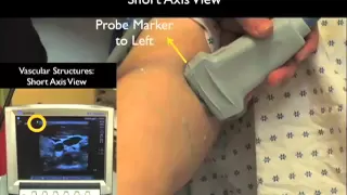 How to: Peripheral Venous Access Under Ultrasound Guidance Case Study Part 1