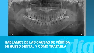 Hablamos de las causas de pérdida de hueso dental y cómo tratarla