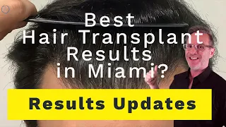 Amazing Hair Transplant Results in Miami