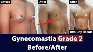 Gynecomastia Surgery Grade 2 Before After Results