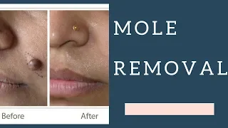 MOLE REMOVAL WITH LASER : DR. ANVIKA