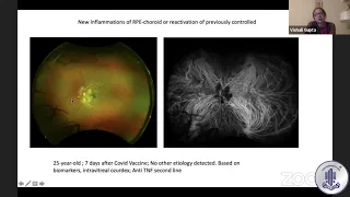 Immune mediated ocular inflammation due to COVID and COVID vaccinations by Dr Vishali Gupta