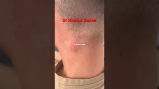 Massive cyst explosion #shorts #blackheads #skincare Dr Khaled Sadek LIPOMACYST clinic