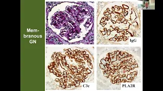 What is new in KDIGO 2021 guidelines on glomerular diseases? - Prof. Juergen Floege