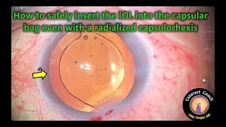 Prevent posterior extension of a capsular break during cataract surgery