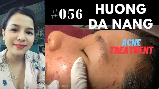 #056 | ACNE TREATMENT for young pretty girl | Being recorded before Social distancing