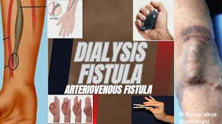 AV Fistula | Arteriovenous Fistula | Dialysis Fistula | Dialysis access | Hemodialysis Access