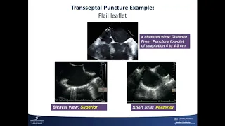 Course 13: Percutaneous Transseptal Access, TMVR, & Mitral Valve-in-Valve Replacement