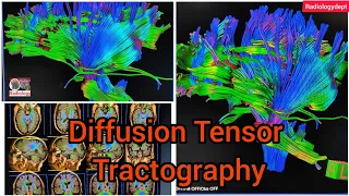 Diffusion Mri Fiber Tensor imaging #tractography of the Brain | Siemens tractography in Hindi #Mri