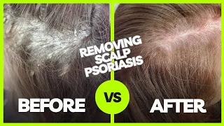 Removing Plaque Scalp Psoriasis | Using The Anti-Fungal Bundle myhappyscalp.com