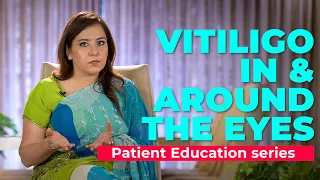 Vitiligo in & around the eyes | Dr Nitika Kohli |
