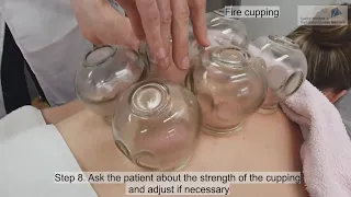 Cupping