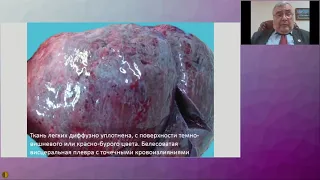 Патологическая анатомия и вопросы патогенеза инфекции COVID-19 -  Кактурский Лев Владимирович