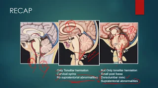 CHIARI MALFORMATIONS RADIOLOGY CT MRI