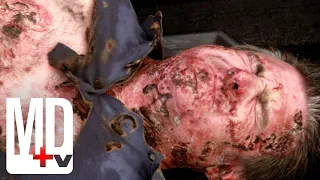 Deep Fried Turkey Results in Fourth Degree Burns | Trauma | MD TV