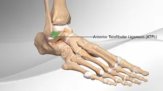 Chronic Ankle Sprain Repair With the InternalBrace™ Ligament Augmentation Procedure