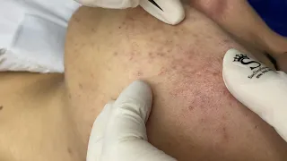 Acne Treament Under The Skin #005