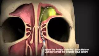 Balloon Sinuplasty Animation - Frontal Sinuses