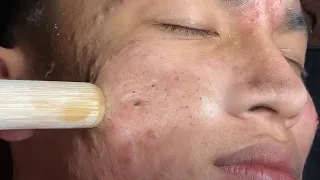 Make your Acne Treatment Huong Da Nang Part 2 | 433 # acne 2022